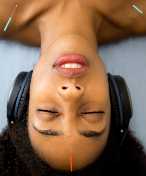 I Tried Acupuncture For the First Time